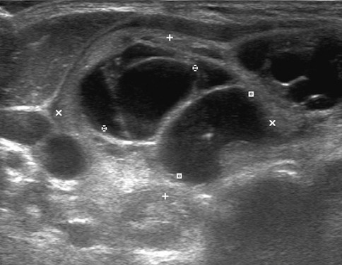 УЗИ щитовидной железы - снимок