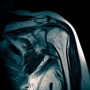 Снимок МРТ сустава