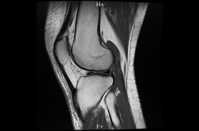 Снимок МРТ коленного сустава