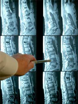 Что визуализируется на МРТ шейного отдела позвоночника с ангиографией?