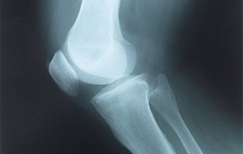 Рентген коленного сустава в Симферополе | Клиника 