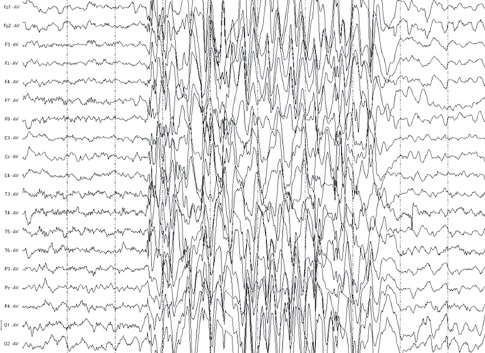 Что показывает ЭЭГ при эпилепсии - электроэнцефалограмма