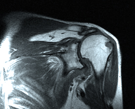 Снимок МРТ плечевого сустава