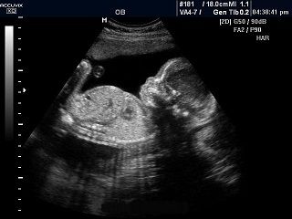 12 неделя беременности - размер плода, пол ребенка на узи, фото животиков - Дети витамин-п-байкальский.рф