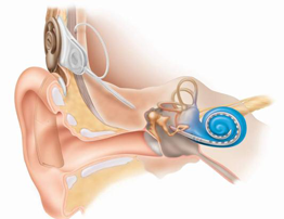Противопоказания: слуховой имплант