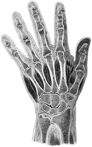 Рентген запястья руки человека, трещина или перелом костей.