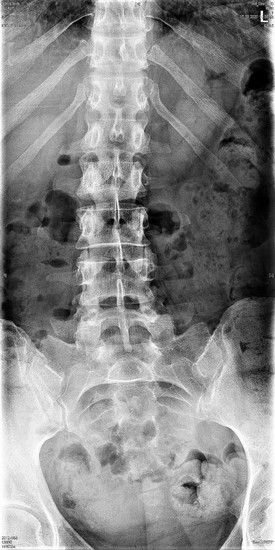 Рентген позвоночника в двух проекциях