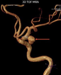 МР-артериограма аневризма