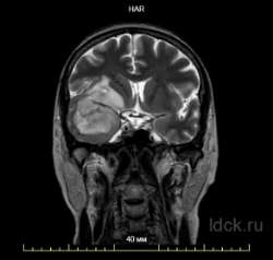 МРТ снимок: олигодендроглиома височной доли