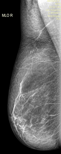 рентгенография молочной железы (правая сторона)