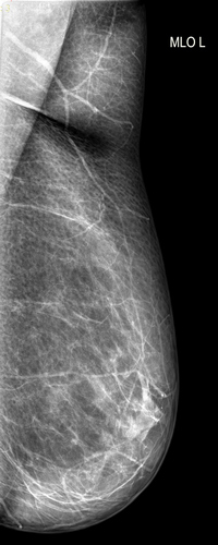 рентгенография молочной железы (левая сторона)