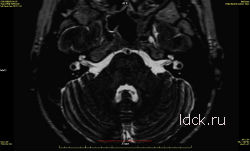 Снимок МРТ внутреннего уха норма