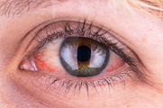 Заболевания сетчатки глаз и лечение