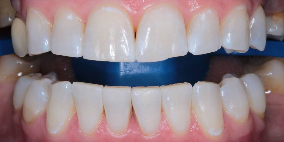 Отбеливание зубов