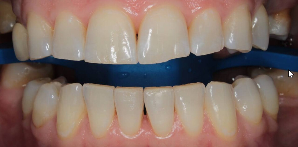 Отбеливание зубов