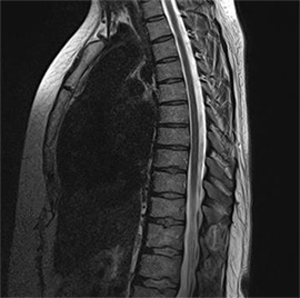 Грыжа грудного отдела фото