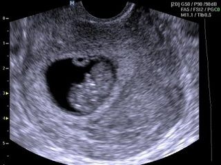 Снимок узи 2 недели беременности фото