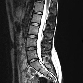 Мр картина дистрофических изменений пояснично крестцового отдела позвоночника
